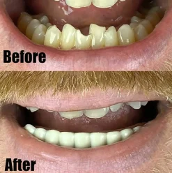 BOTTOM TEETH lower VENEER false Cosmetic secure smile